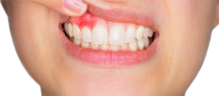 absceso-dental