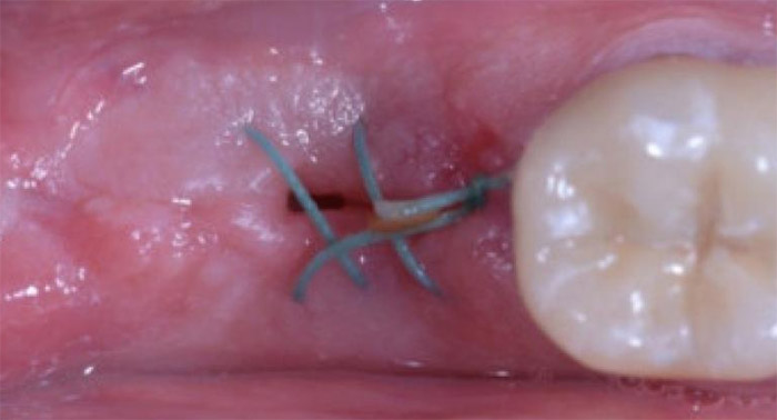 Extracción dental quirúrgica