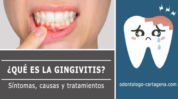 Que es la gingivitis