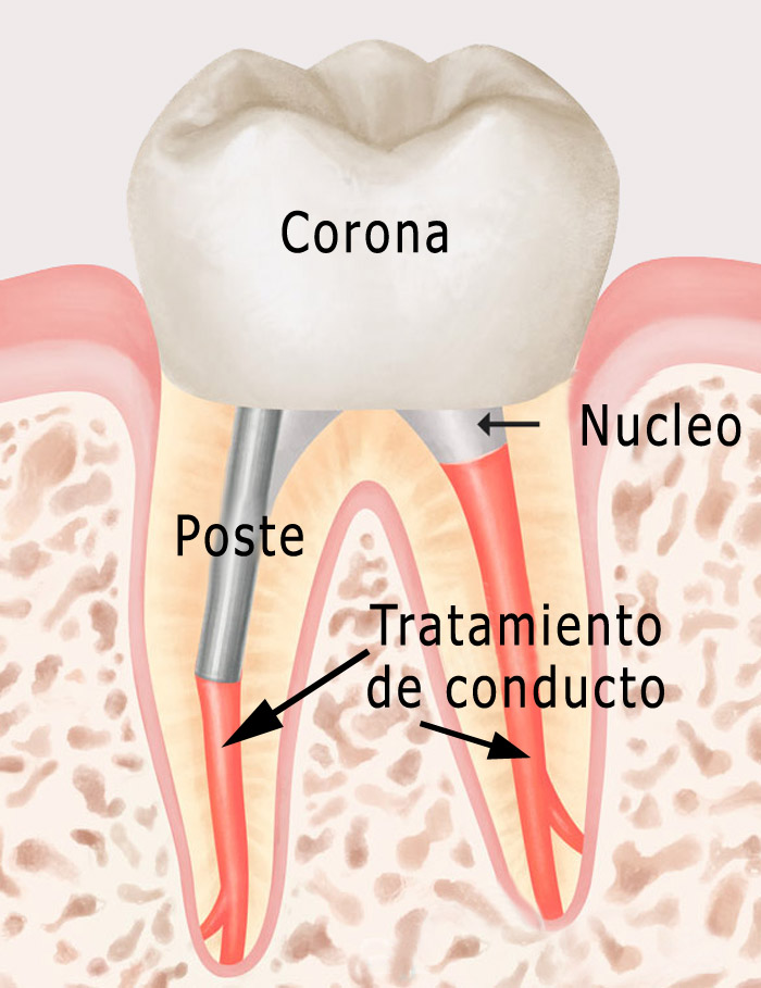 Nucleo dental estructura