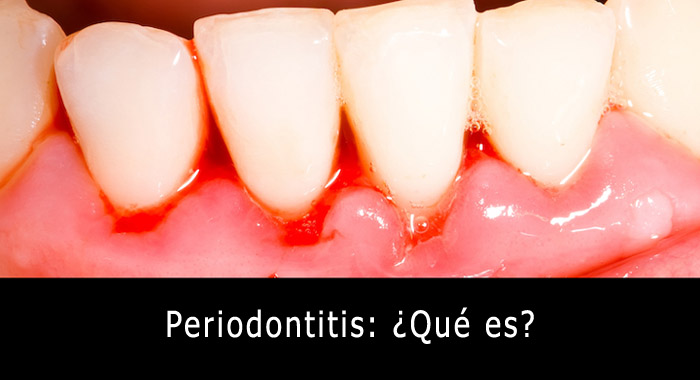 periodontitis-que-es