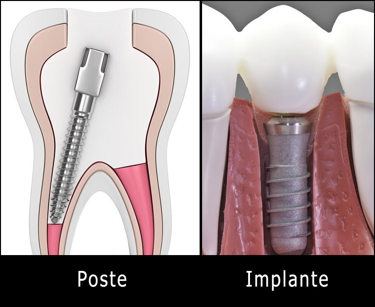 poste-implante-1