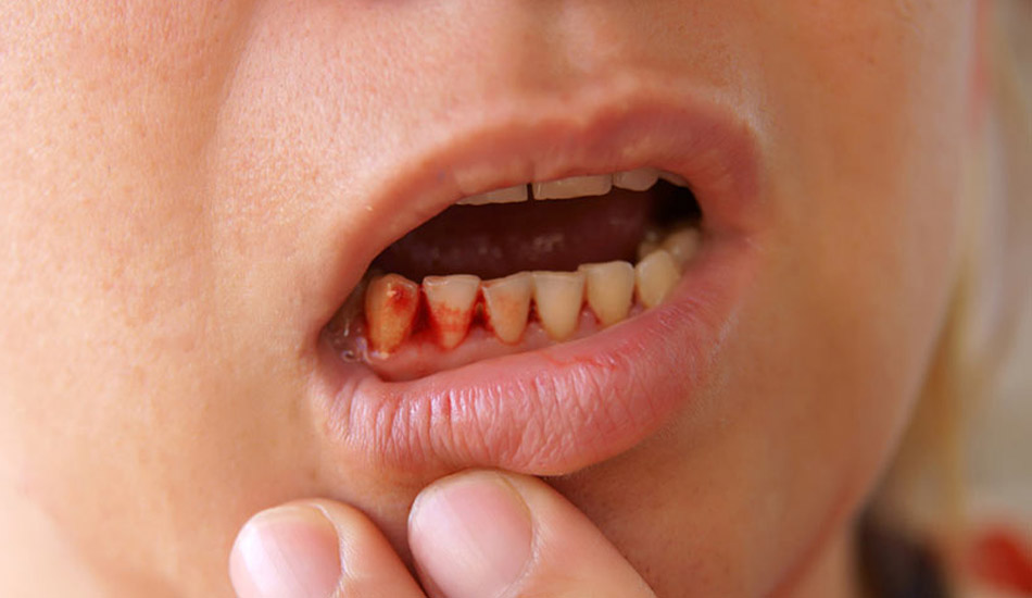 Urgencias dentales que provocan hemorragia