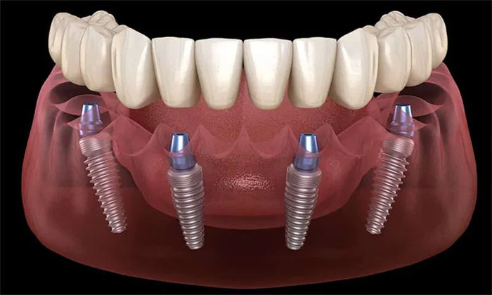 Qué es un All-on-4 o prótesis dental fija