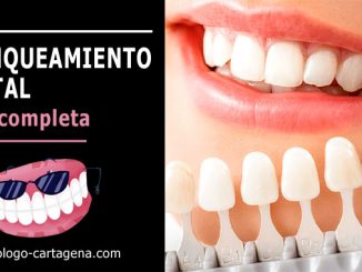 Blanqueamiento dental Cartagena