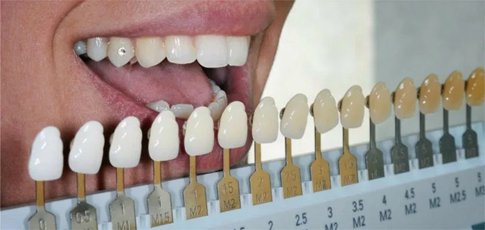 Cuál es el tono de un diente natural