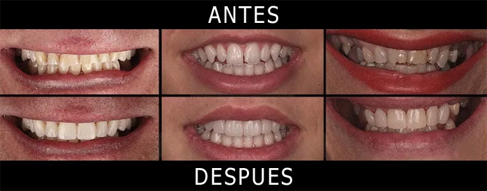 Carillas dentales antes y despues