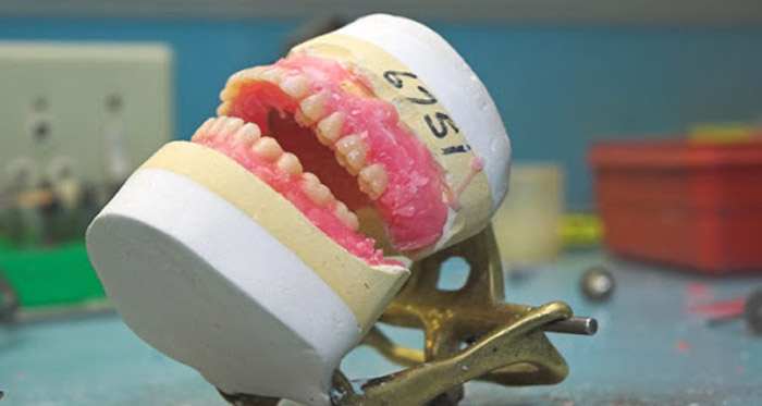 Cómo se hace una dentadura completa