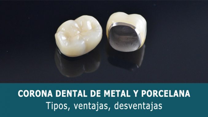 Corona dental de metal y porcelana