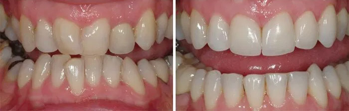 Dientes torcidos antes y despues