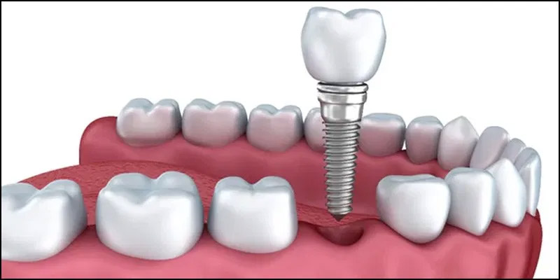 implante-dental