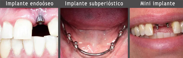 Tipos de implante dental