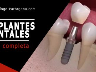 Implantes dentales en Cartagena Colombia