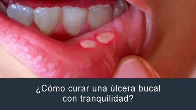 ulcera-bucal úlcera bucal