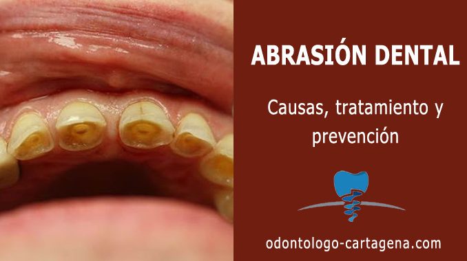 Abrasion dental