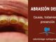 Abrasion dental