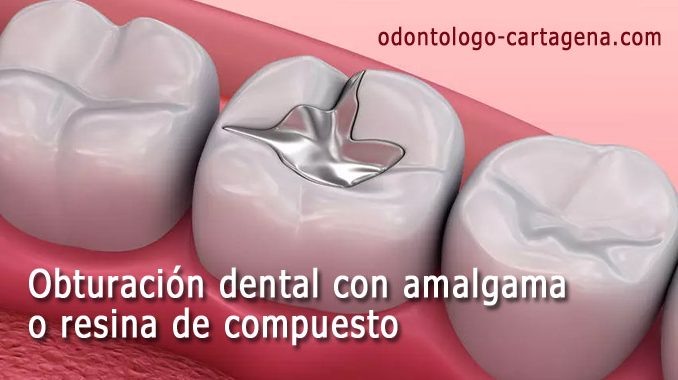 Obturación dental amalgama