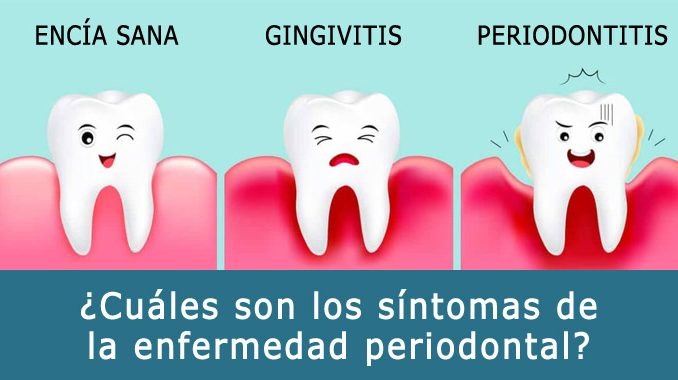 ¿Cuáles son los síntomas de la enfermedad periodontal?