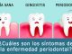 ¿Cuáles son los síntomas de la enfermedad periodontal?