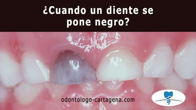 diente-negro ¿Cuando un diente se pone negro?