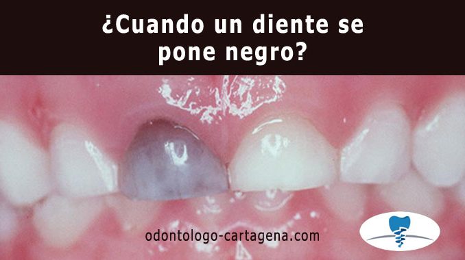 ¿Cuando un diente se pone negro?