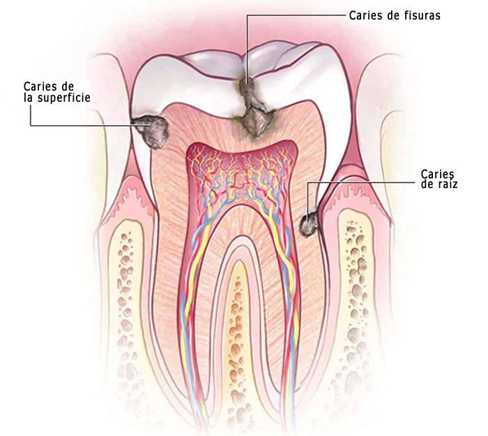 Tipos de caries dentales