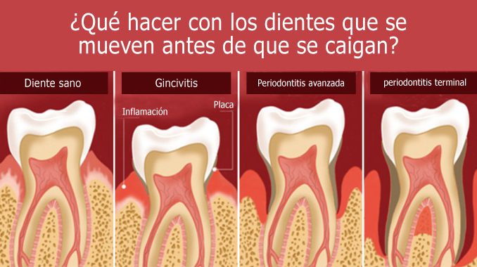 Dientes que se mueven