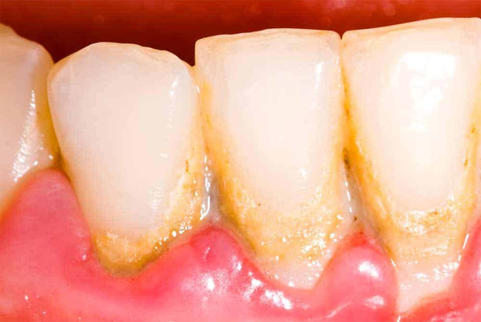 plaque-dentaire