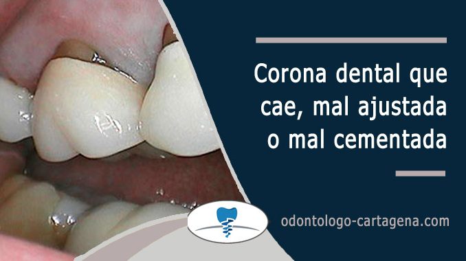 Corona dental que se cae