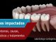 Dientes impactados