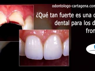 corona dental para los dientes frontales