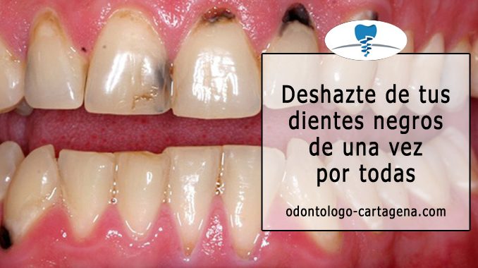 dientes negros